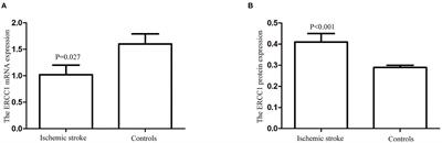 ERCC1 polymorphism and its expression associated with ischemic stroke in Chinese population